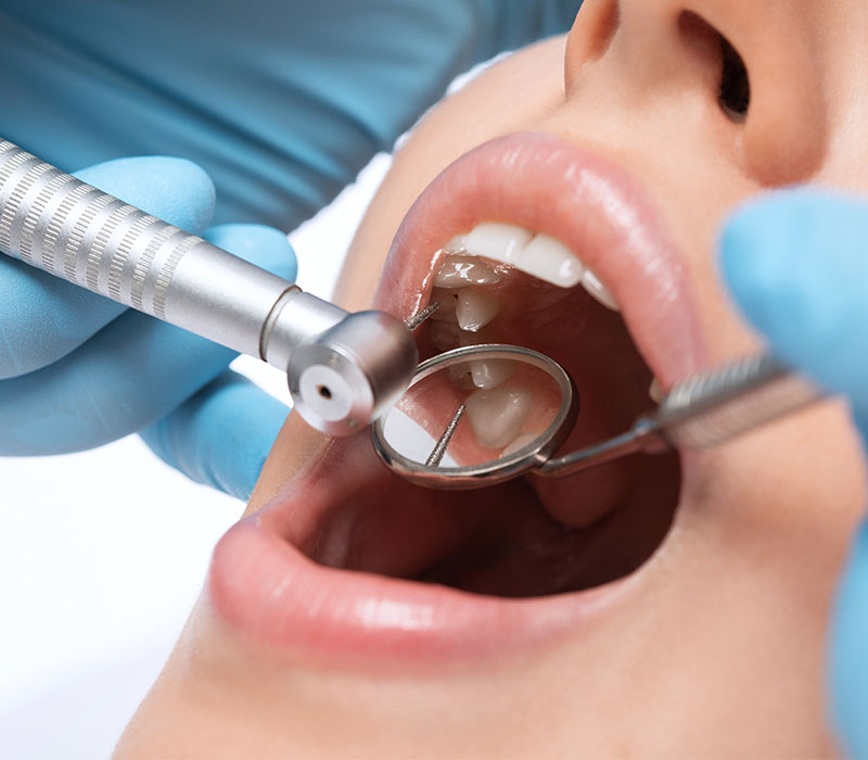 Conservativa e ricostruzioni dentali Cura delle carie