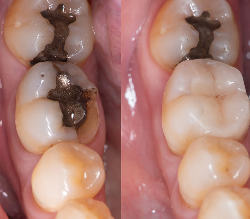 Conservativa e ricostruzioni dentali Ricostruzione dentale