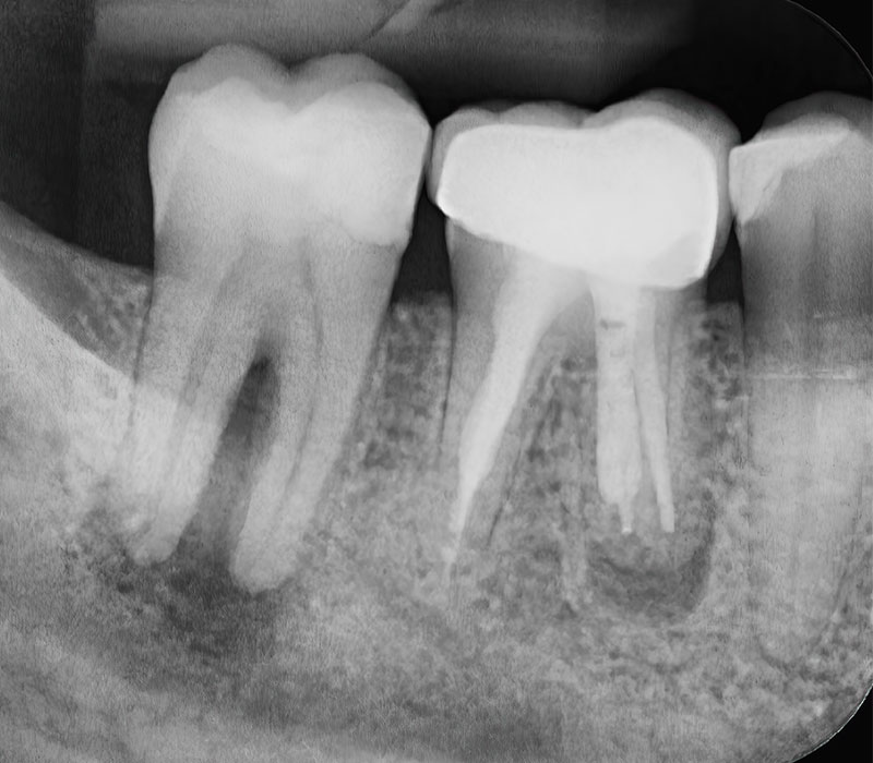 Endodonzia Lastra di una dente devitalizzato