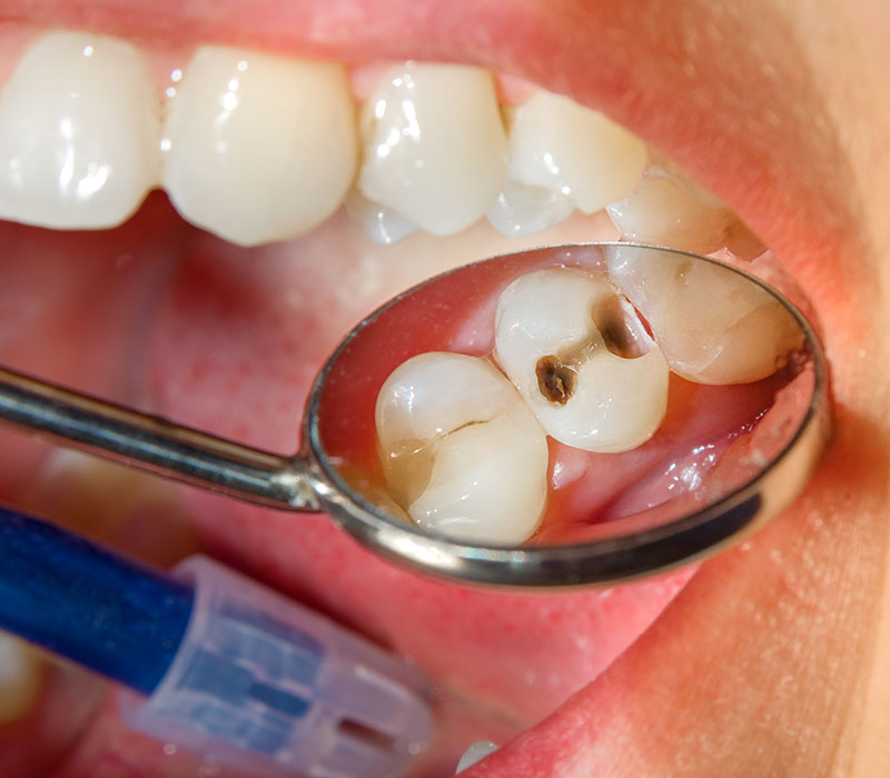 Endodonzia Devitalizzazione di un dente